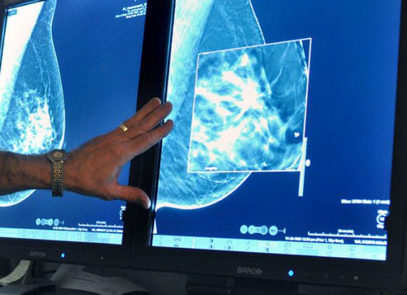Certain Hispanic women more likely to die of breast cancer than others
