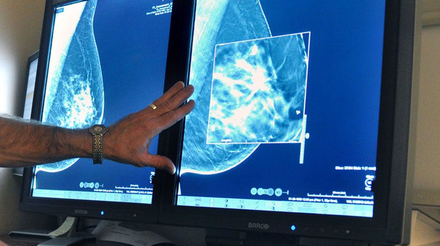 Certain Hispanic women more likely to die of breast cancer than others